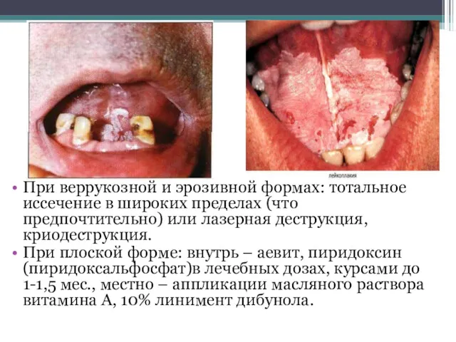 Лейкоплакия При веррукозной и эрозивной формах: тотальное иссечение в широких