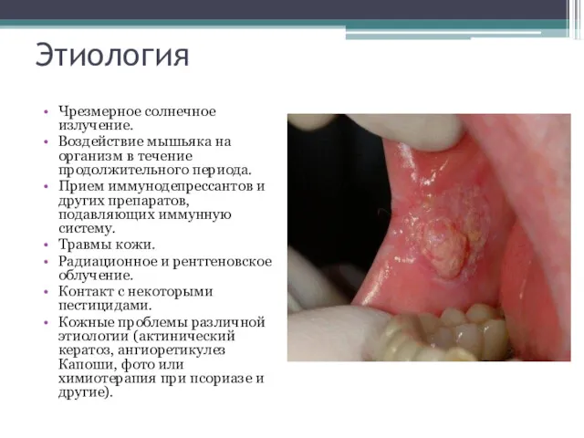 Этиология Чрезмерное солнечное излучение. Воздействие мышьяка на организм в течение