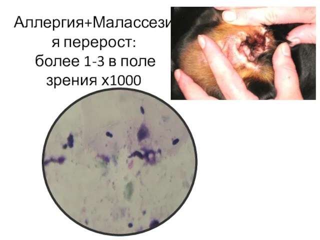 Аллергия+Малассезия перерост: более 1-3 в поле зрения х1000