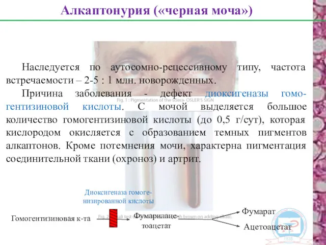 Наследуется по аутосомно-рецессивному типу, частота встречаемости – 2-5 : 1