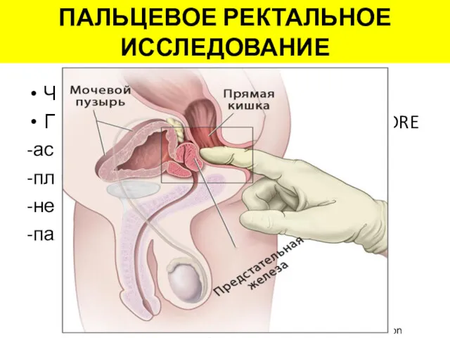 ПАЛЬЦЕВОЕ РЕКТАЛЬНОЕ ИССЛЕДОВАНИЕ Чаще периферическая зона При объеме >0,2 мл