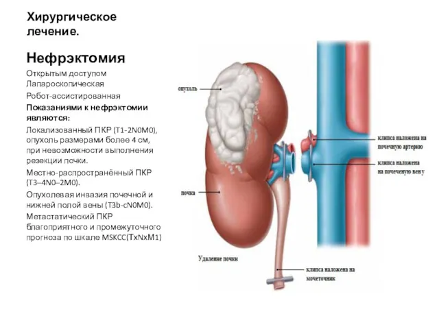 Хирургическое лечение. Нефрэктомия Открытым доступом Лапароскопическая Робот-ассистированная Показаниями к нефрэктомии