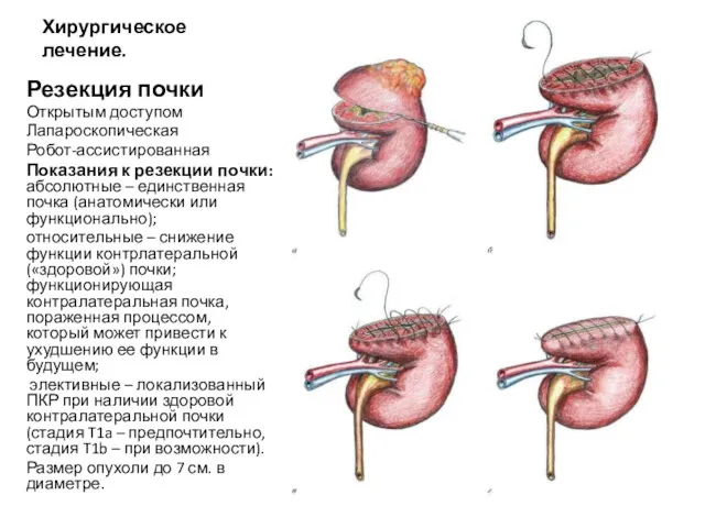 Хирургическое лечение. Резекция почки Открытым доступом Лапароскопическая Робот-ассистированная Показания к