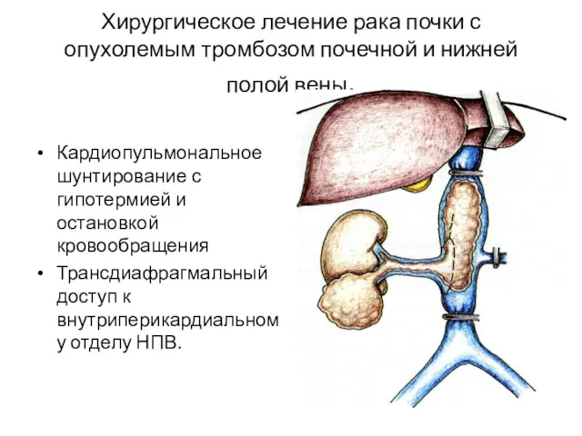 Хирургическое лечение рака почки с опухолемым тромбозом почечной и нижней