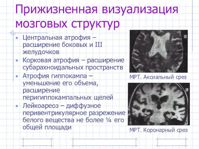 Прижизненная визуализация мозговых структур Центральная атрофия – расширение боковых и