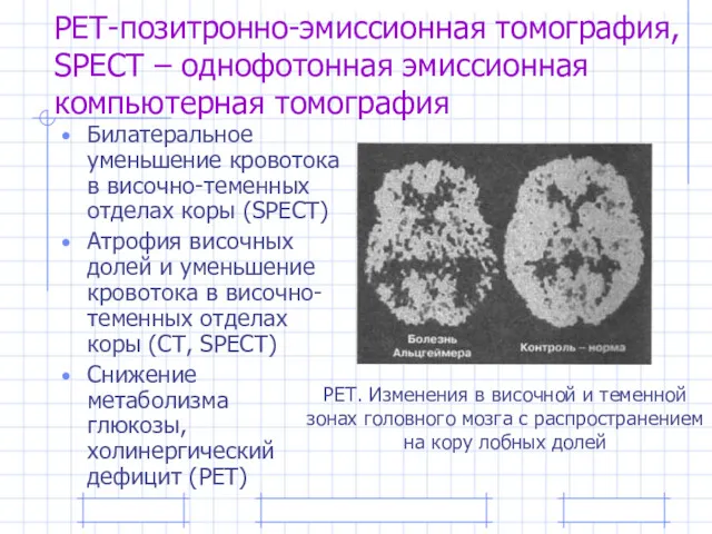 РЕТ-позитронно-эмиссионная томография, SPECT – однофотонная эмиссионная компьютерная томография Билатеральное уменьшение