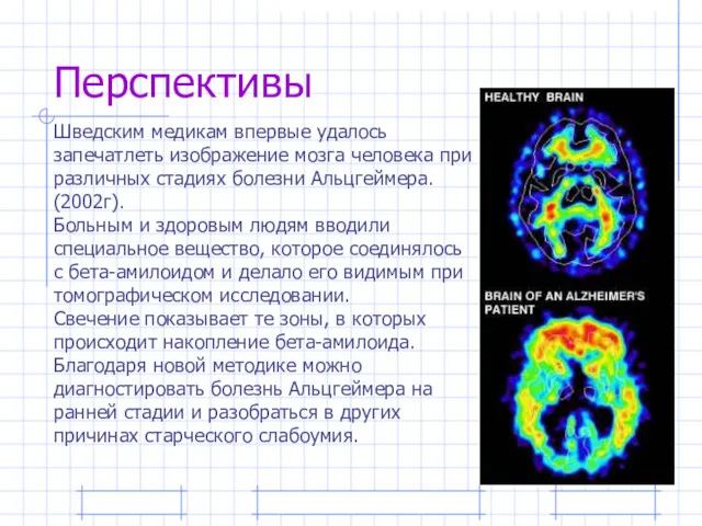 Перспективы Шведским медикам впервые удалось запечатлеть изображение мозга человека при