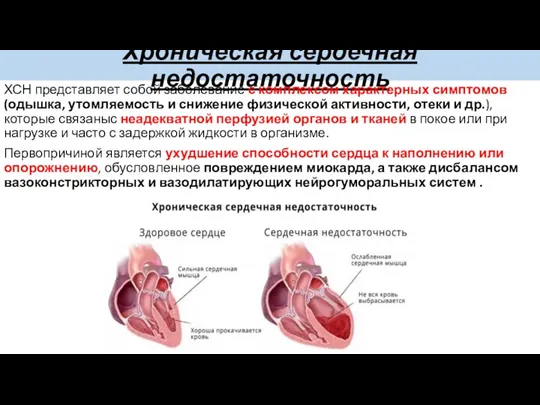 Хроническая сердечная недостаточность ХСН представляет собой заболевание с комплексом характерных симптомов(одышка, утомляемость и