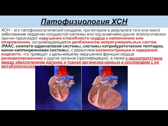 Патофизиология ХСН ХСН – это патофизиологический синдром, при котором в результате того или