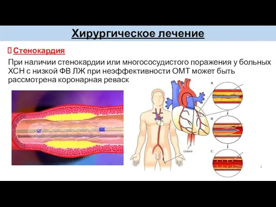 Хирургическое лечение Стенокардия При наличии стенокардии или многососудистого поражения у