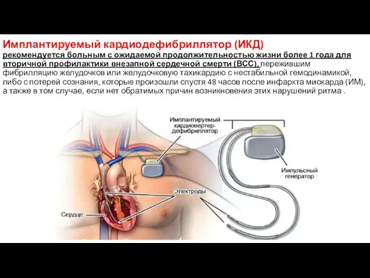 Имплантируемый кардиодефибриллятор (ИКД) рекомендуется больным с ожидаемой продолжительностью жизни более