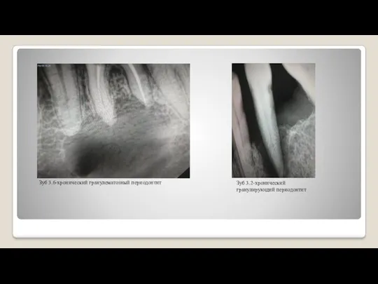Зуб 3.6-хронический гранулематозный периодонтит Зуб 3.2-хронический гранулирующий периодонтит