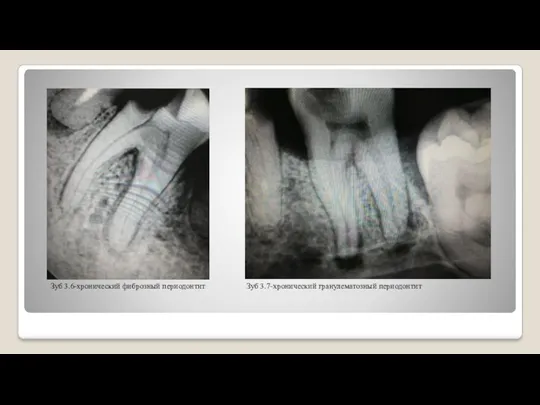 Зуб 3.6-хронический фиброзный периодонтит Зуб 3.7-хронический гранулематозный периодонтит