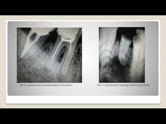 Зуб 4.6-хронический гранулирующий периодонтит Зуб 3.2-хронический гранулирующий периодонтит