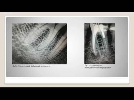 Зуб 4.6-хронический фиброзный периодонтит Зуб 3.6-хронический гранулематозный периодонтит