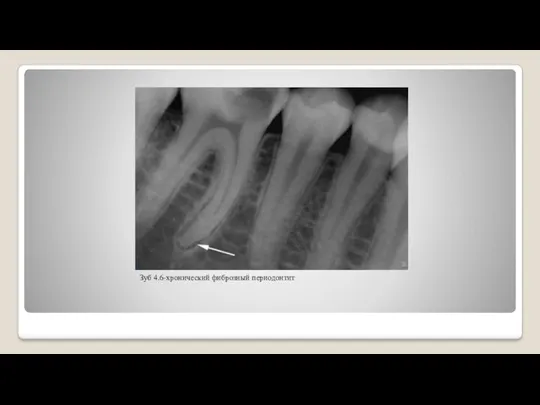 Зуб 4.6-хронический фиброзный периодонтит