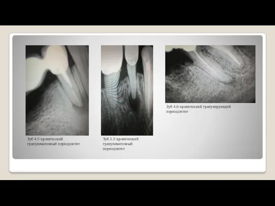 Зуб 4.5-хронический гранулематозный периодонтит Зуб 3.2-хронический гранулематозный периодонтит Зуб 4.6-хронический гранулирующий периодонтит