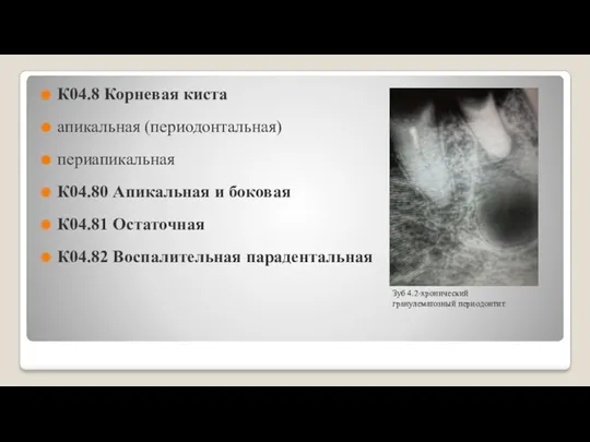 К04.8 Корневая киста апикальная (периодонтальная) периапикальная К04.80 Апикальная и боковая К04.81 Остаточная К04.82