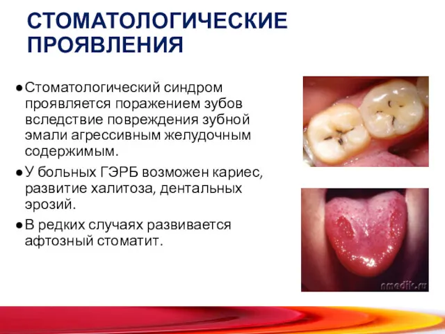 СТОМАТОЛОГИЧЕСКИЕ ПРОЯВЛЕНИЯ Стоматологический синдром проявляется поражением зубов вследствие повреждения зубной эмали агрессивным желудочным