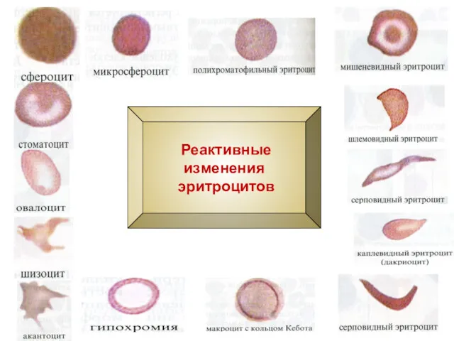 Реактивные изменения эритроцитов