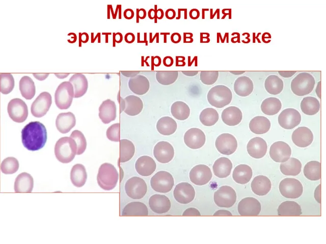 Морфология эритроцитов в мазке крови