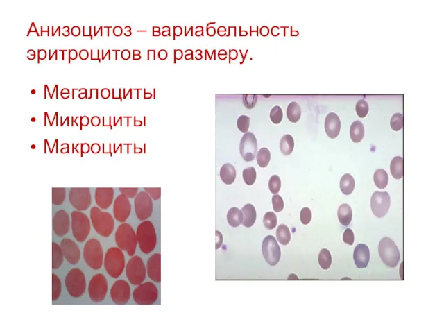 Анизоцитоз – вариабельность эритроцитов по размеру. Мегалоциты Микроциты Макроциты