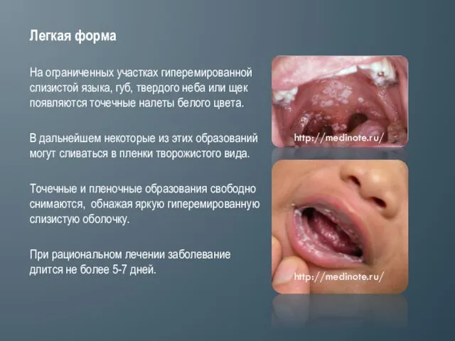 Легкая форма На ограниченных участках гиперемированной слизистой языка, губ, твердого неба или щек
