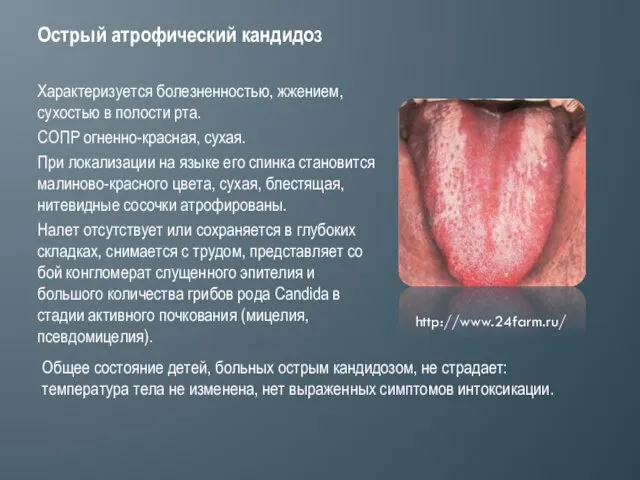 Острый атрофический кандидоз Харак­теризуется болезненностью, жжением, сухостью в полости рта. СОПР огненно­-красная, сухая.