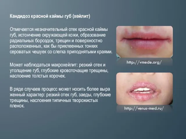 Кандидоз красной каймы губ (хейлит) Отмечается незначительный отек красной каймы губ, истончение окружающей