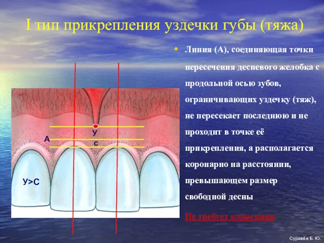 I тип прикрепления уздечки губы (тяжа) Линия (А), соединяющая точки пересечения десневого желобка