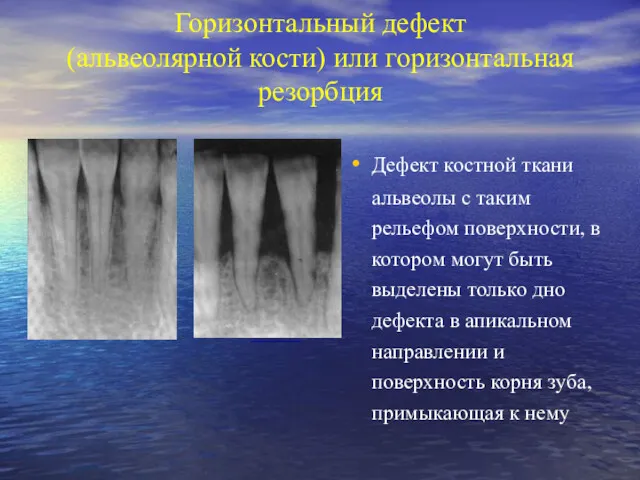 Горизонтальный дефект (альвеолярной кости) или горизонтальная резорбция Дефект костной ткани альвеолы с таким