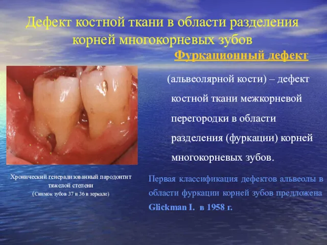 Дефект костной ткани в области разделения корней многокорневых зубов Фуркационный дефект (альвеолярной кости)