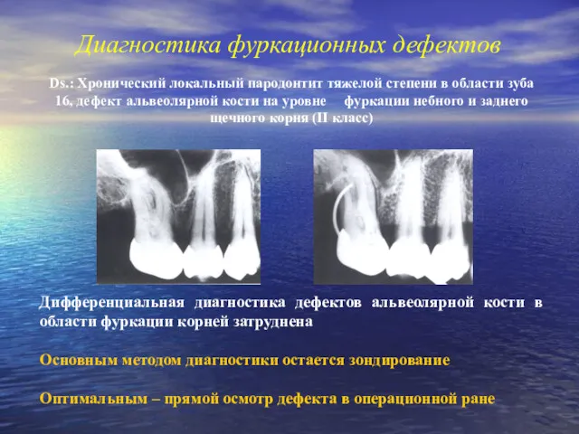 Диагностика фуркационных дефектов Дифференциальная диагностика дефектов альвеолярной кости в области фуркации корней затруднена