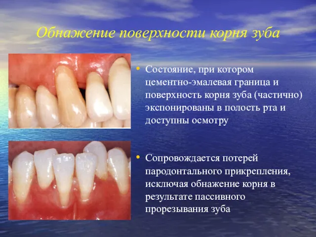 Обнажение поверхности корня зуба Состояние, при котором цементно-эмалевая граница и поверхность корня зуба