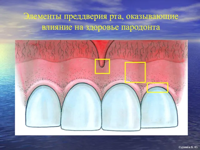 Элементы преддверия рта, оказывающие влияние на здоровье пародонта Суражёв Б. Ю.