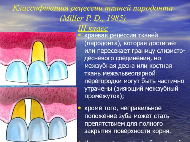 Классификация рецессии тканей пародонта (Miller P. D., 1985) III класс краевая рецессия тканей