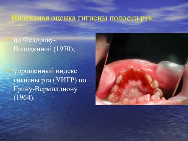 Индексная оценка гигиены полости рта: по Федорову-Володкиной (1970); упрощенный индекс гигиены рта (УИГР) по Грину-Вермиллиону (1964).