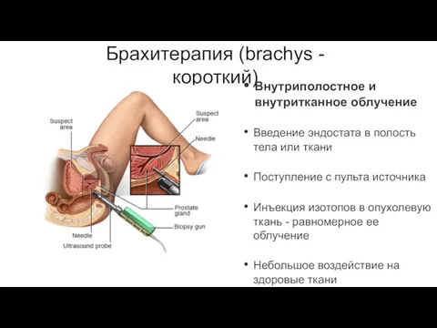 Брахитерапия (brachys -короткий) Внутриполостное и внутритканное облучение Введение эндостата в