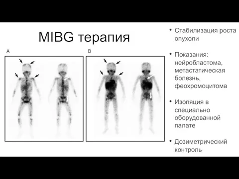 MIBG терапия Стабилизация роста опухоли Показания: нейробластома, метастатическая болезнь, феохромоцитома