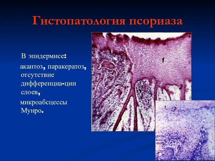 Гистопатология псориаза В эпидермисе: акантоз, паракератоз, отсутствие дифференциа-ции слоев, микроабсцессы Мунро.