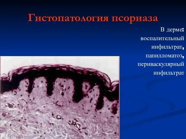 Гистопатология псориаза В дерме: воспалительный инфильтрат, папилломатоз, периваскулярный инфильтрат