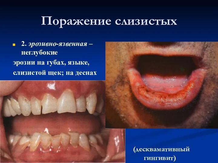 Поражение слизистых 2. эрозивно-язвенная – неглубокие эрозии на губах, языке, слизистой щек; на деснах (десквамативный гингивит)