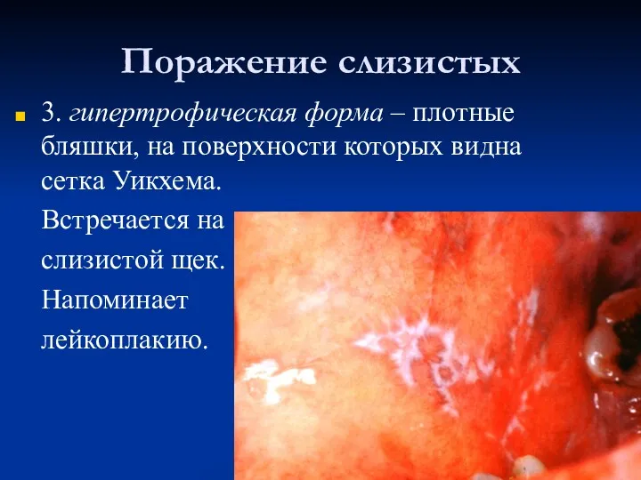 Поражение слизистых 3. гипертрофическая форма – плотные бляшки, на поверхности