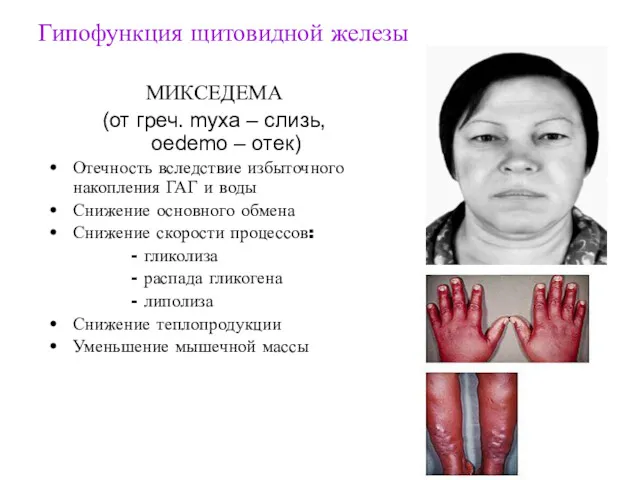 Гипофункция щитовидной железы МИКСЕДЕМА (от греч. myxa – слизь, oedemo