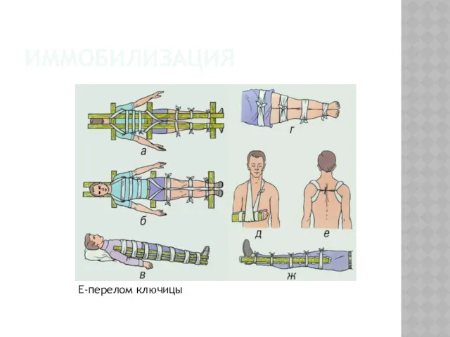 ИММОБИЛИЗАЦИЯ Е-перелом ключицы