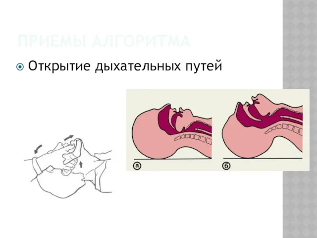 ПРИЕМЫ АЛГОРИТМА Открытие дыхательных путей