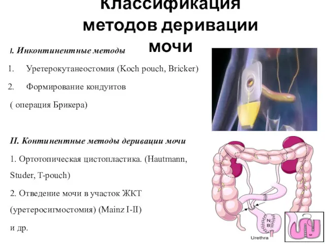 I. Инконтинентные методы Уретерокутанеостомия (Koch pouch, Bricker) Формирование кондуитов (