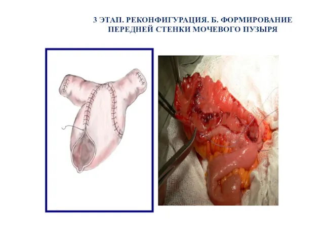 3 ЭТАП. РЕКОНФИГУРАЦИЯ. Б. ФОРМИРОВАНИЕ ПЕРЕДНЕЙ СТЕНКИ МОЧЕВОГО ПУЗЫРЯ