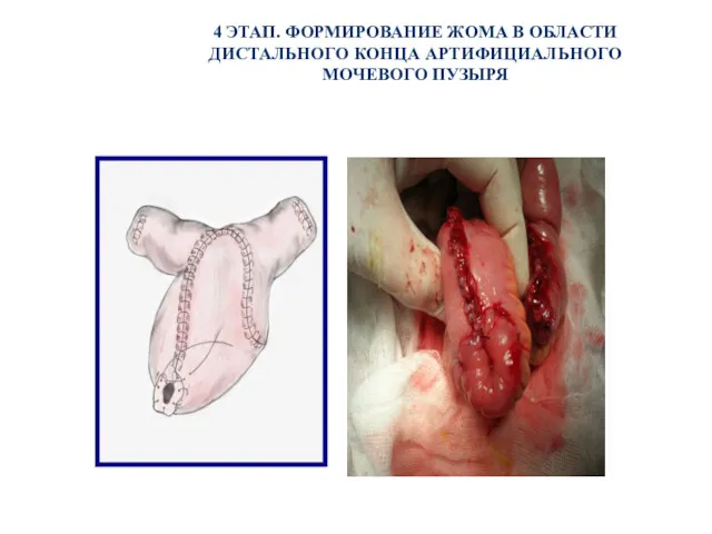 4 ЭТАП. ФОРМИРОВАНИЕ ЖОМА В ОБЛАСТИ ДИСТАЛЬНОГО КОНЦА АРТИФИЦИАЛЬНОГО МОЧЕВОГО ПУЗЫРЯ