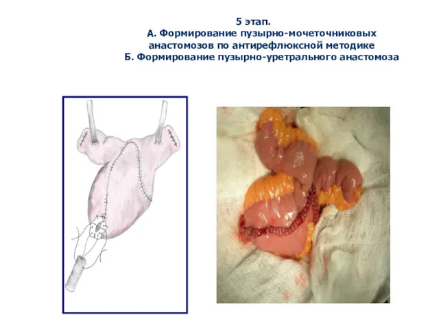 5 этап. А. Формирование пузырно-мочеточниковых анастомозов по антирефлюксной методике Б. Формирование пузырно-уретрального анастомоза